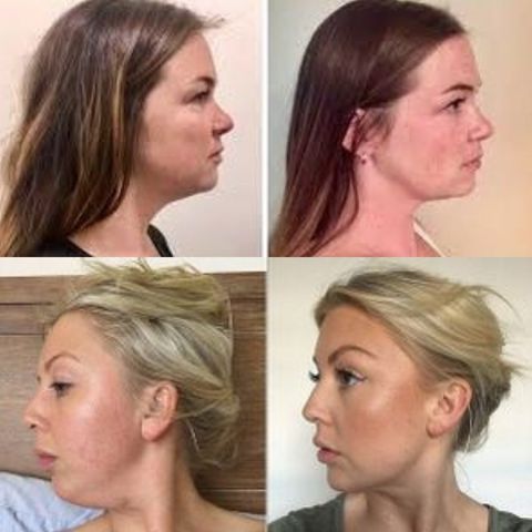  MASAJEADOR BEAUTY FACE REDUCTOR DE ARRUGAS Y PAPADA