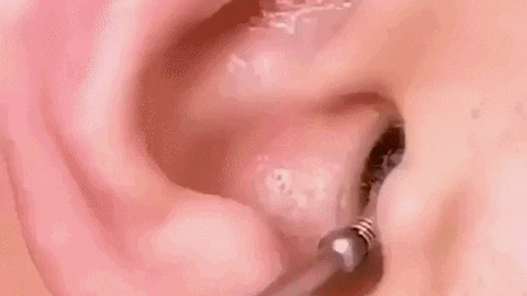 LIMPIA OIDOS KIT X6 PROFESIONAL PORTABLE